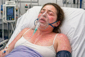 anafilaxie pacient cu reactie alergica severa eruptii cutanate extinse edem facial dificultate respiratorie masca de oxigen imagine medicala realista stil clinic curat