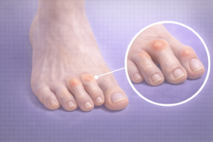 degete in ciocan deformare articulatii degete picior flexie anormala