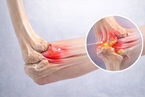 epicondilita laterala inflamatie tendon cot durere partea externa cot