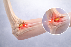 epicondilita mediala inflamatie tendon cot durere partea interna cot