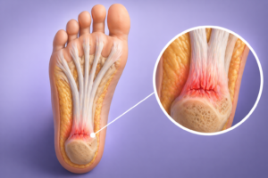 fasceita plantara inflamatie fascia calcai durere talpa