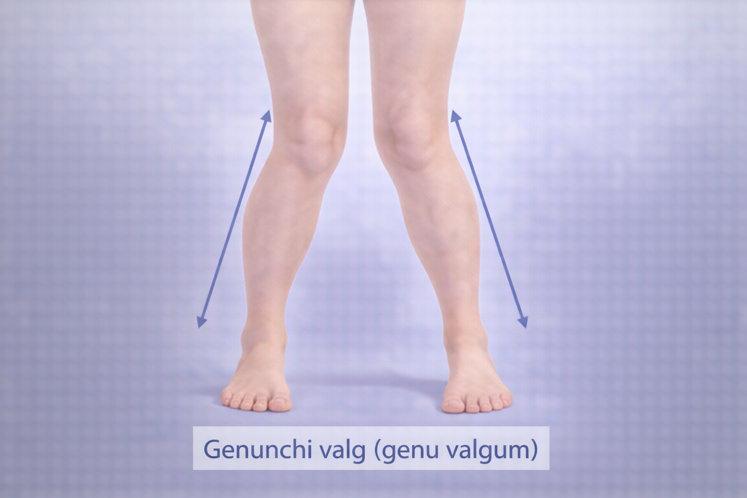 genunchi valg aliniere anormala genunchi apropiati picioare departate