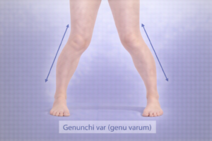 genunchi var aliniere picioare curbate spre exterior genu varum