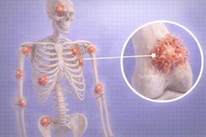 metastaze osoase leziuni multiple schelet afectare cancer os