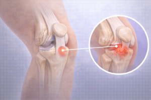 osgood schlatter inflamatie tuberozitate tibiala durere genunchi adolescent