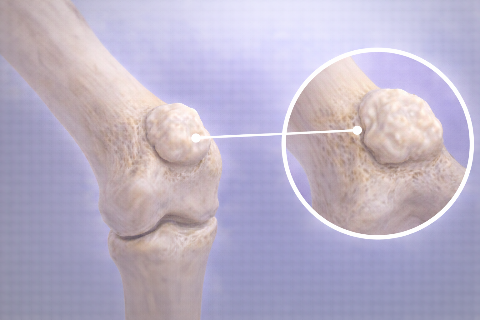 osteom crestere osoasa benigna proeminenta pe os