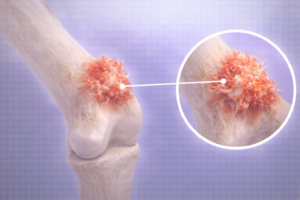 osteosarcom tumora osoasa maligna crestere agresiva os