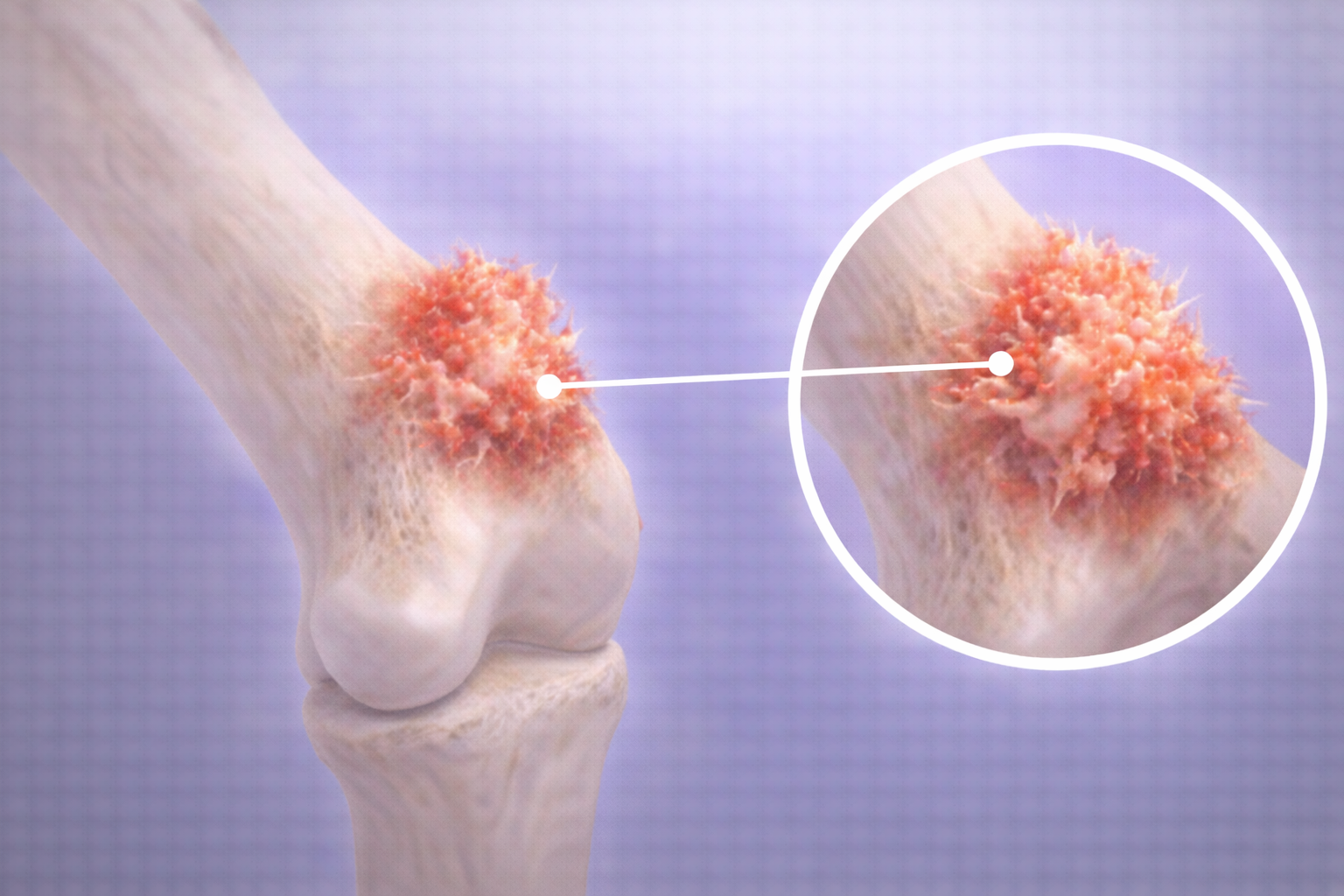 osteosarcom tumora osoasa maligna crestere agresiva os