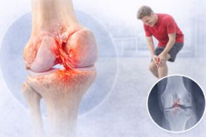 ruptura ligament incrucisat anterior ilustratie medicala genunchi instabilitate lia