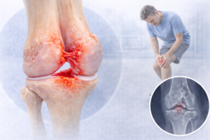 ruptura ligament incrucisat posterior ilustratie medicala genunchi instabilitate lip