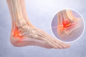 tendinita achileana inflamatie tendon ahile durere calcai posterior