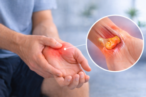 tenosinovita inflamatie teaca tendon durere incheietura mana ilustratie medicala